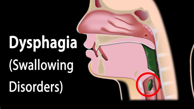Dysphagia Swallowing Disorders Smart Seminars